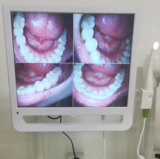 歯科口腔内カメラ1600万画素 （17インチ）